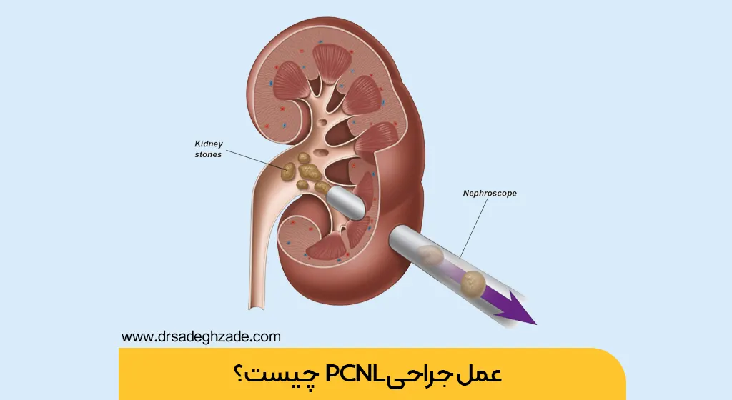 عمل pcnl