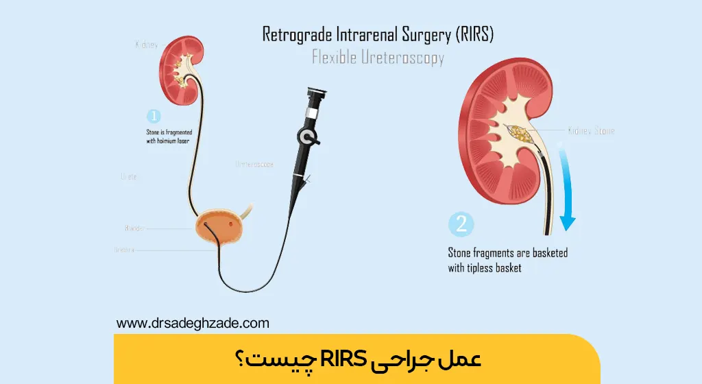 عمل RIRS