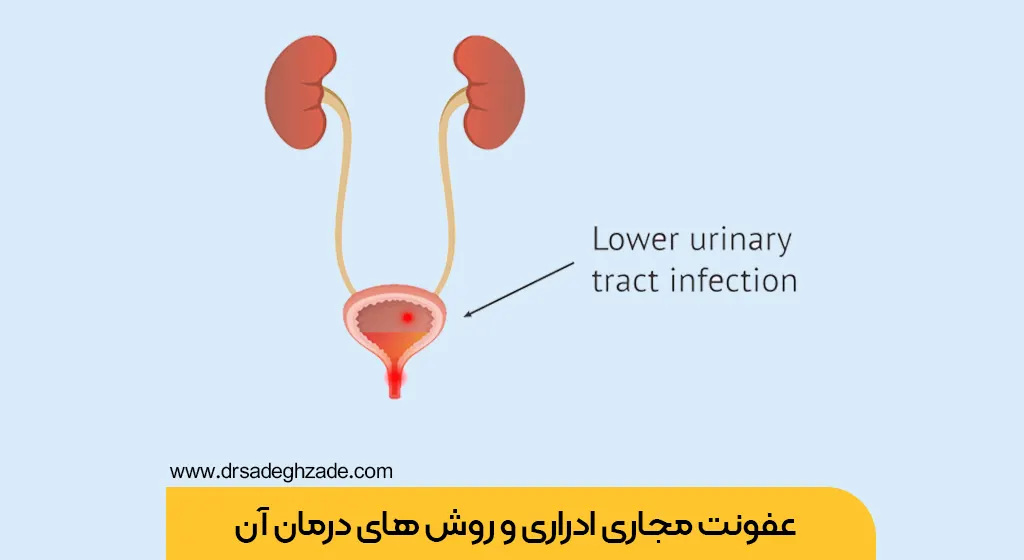 عفونت ادراری