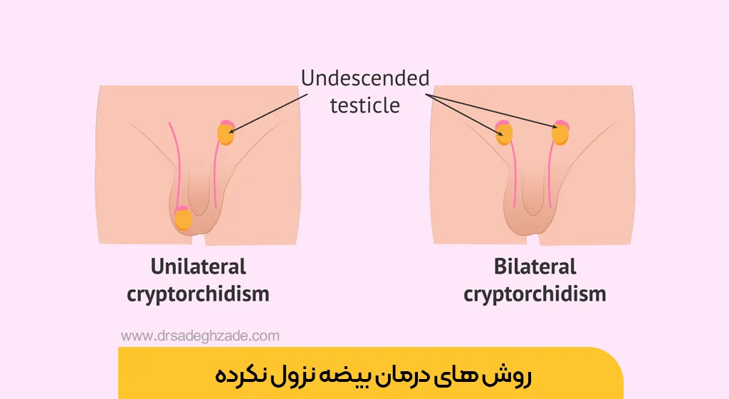 عکس بیضه نزول نکرده