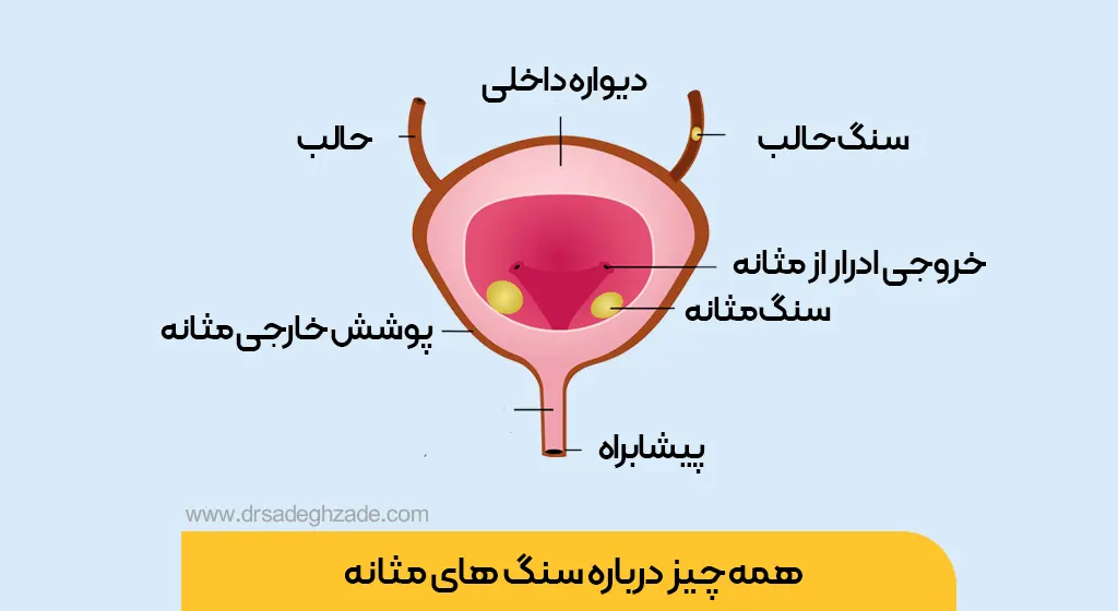 عکس سنگ مثانه