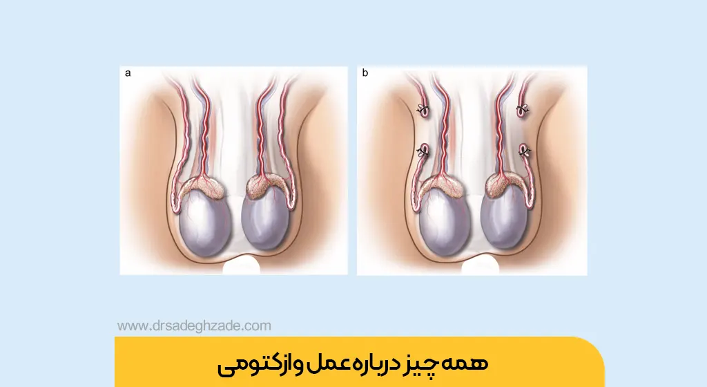 عکس عمل وازکتومی