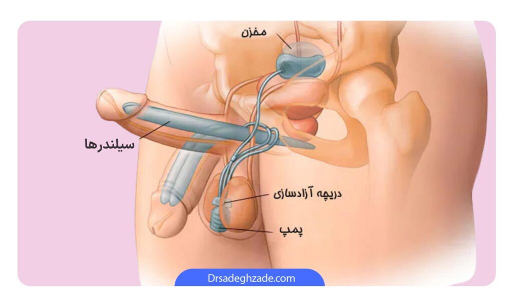 تصویر قسمت های مختلف پروتز آلت تناسلی