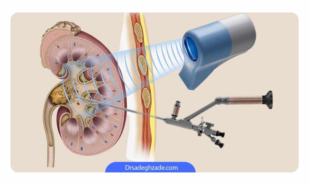تصویر شماتیک از عمل سنگ کلیه