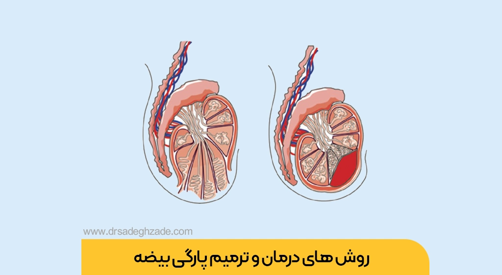 تصویر شاخص روش های ترمیم پارگی بیضه