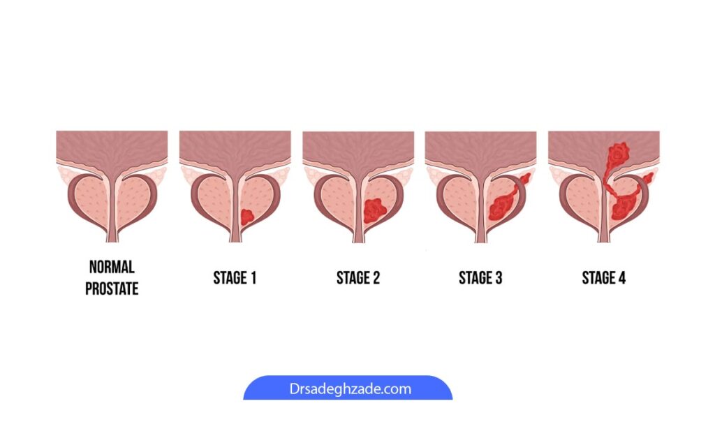 مرحله بندی کنسر پروستات