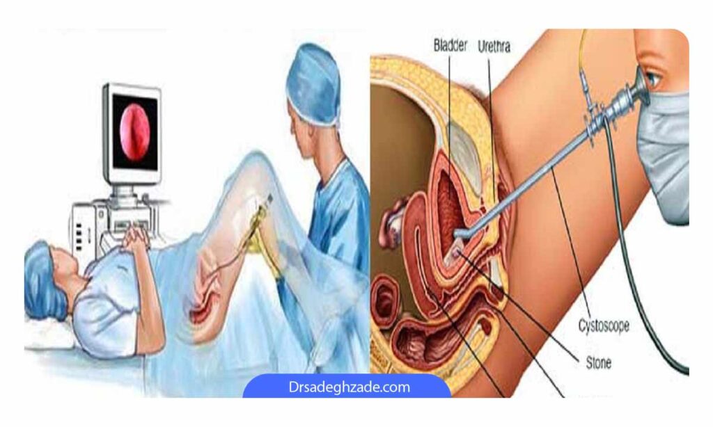 تصویر جراحی سنگ مثانه از روش سیستولیتولاپاکسی