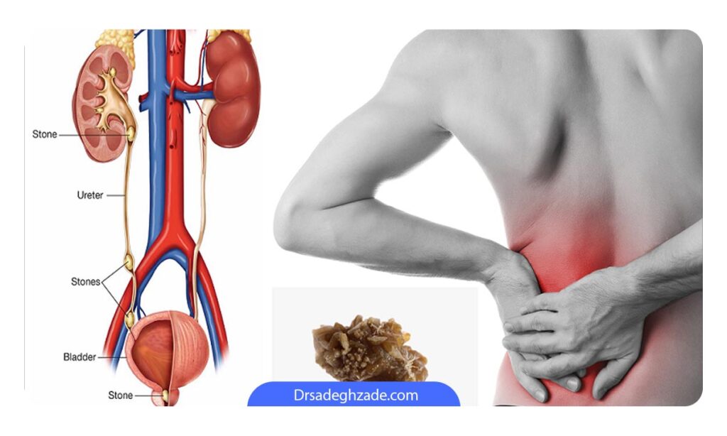 تصویر جایگاه سنگ کلیه در مجاری ادراری 