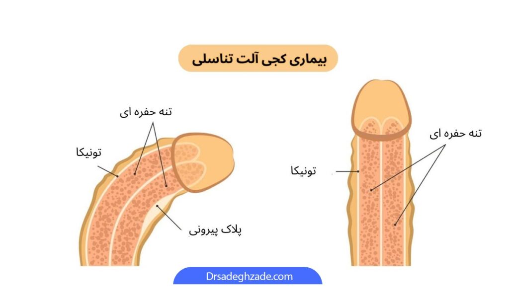 تصویر کجی آلت تناسلی اینفوگرافیک