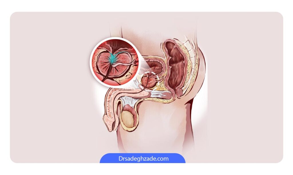 تصویر شماتیک از جایگاه پروستات در اندان تناسلی مردان