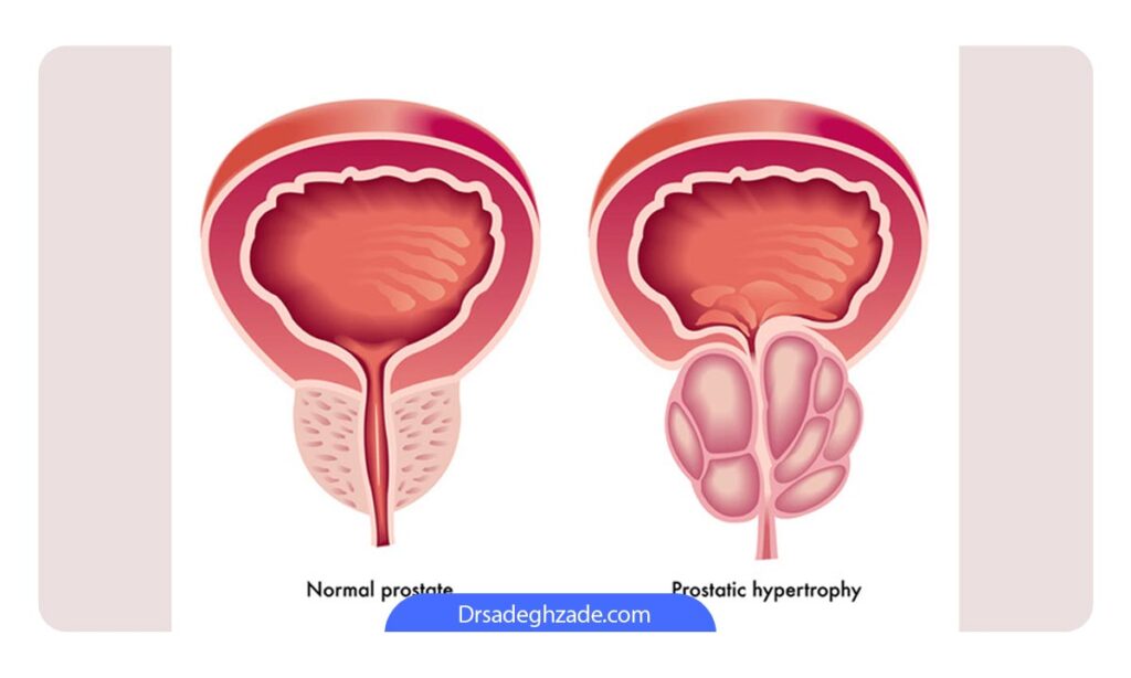عکس از تفاوت پروستات نرمال با پروستات غیر طبیعی