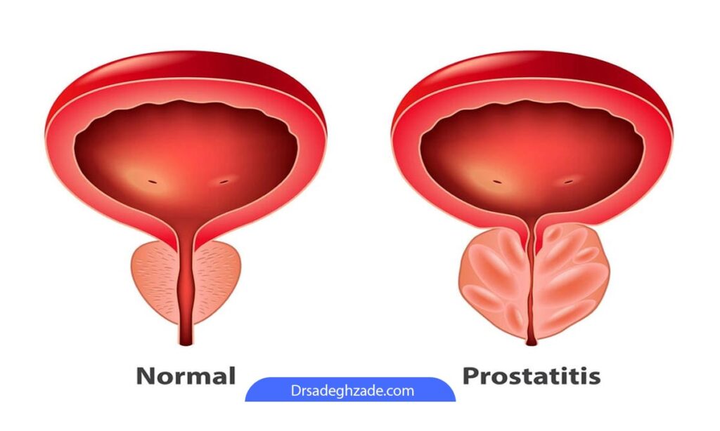 تصویر شماتیک از پروستاتیت