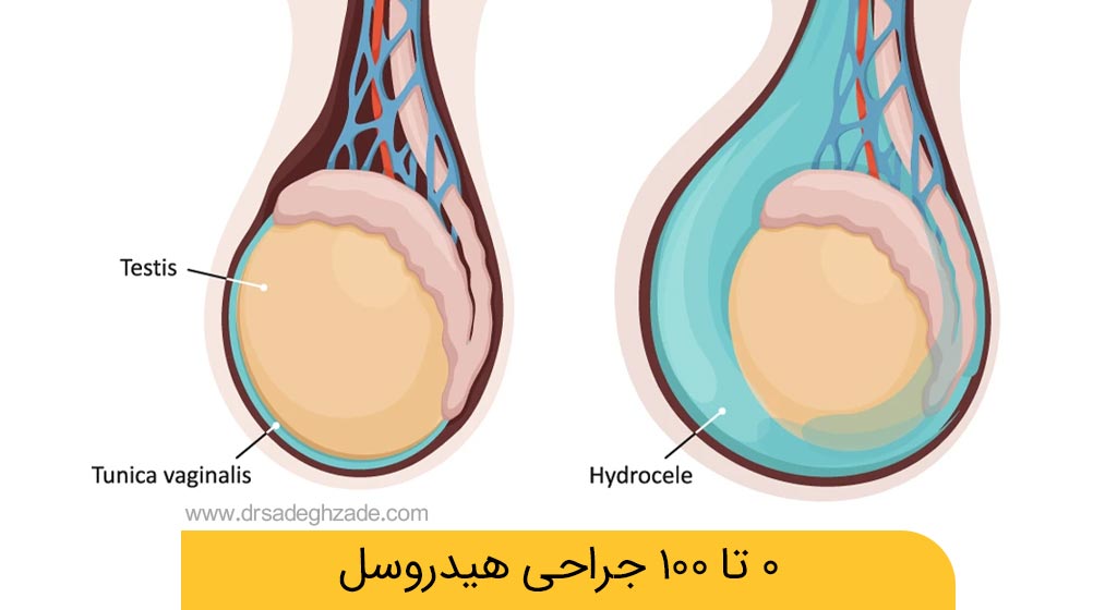 جراحی هیدروسل چیست