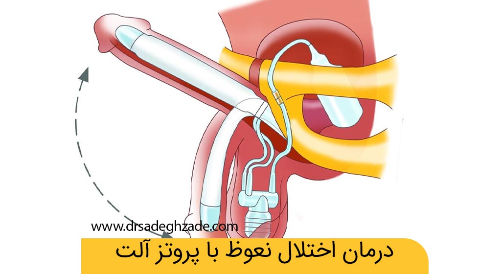 پروتز آلت چیست