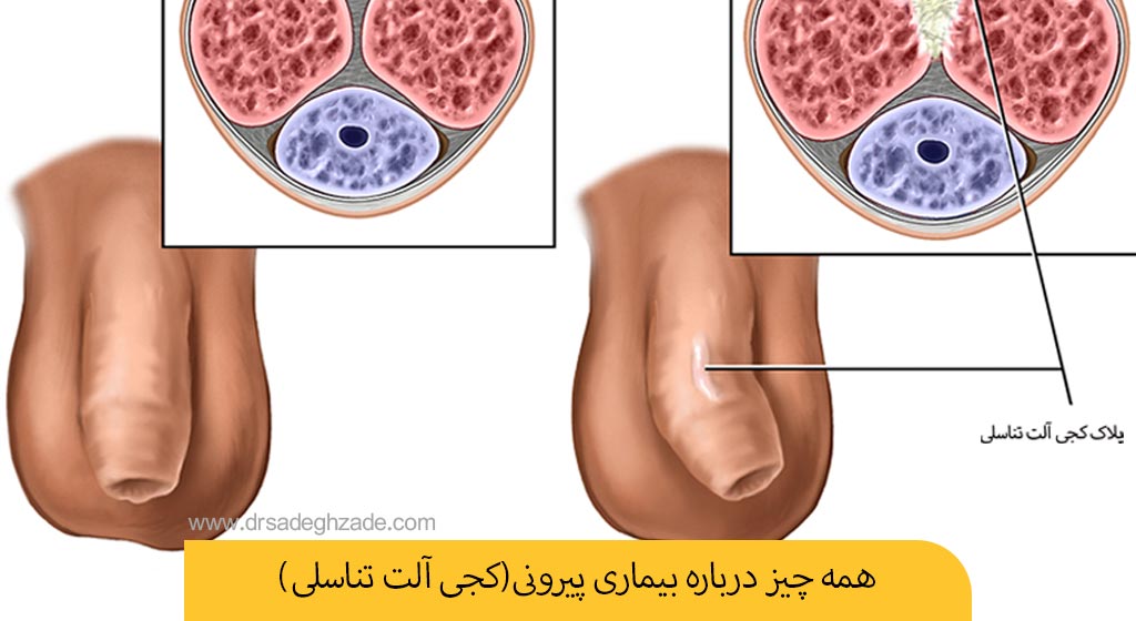 بیماری پیرونی چیست