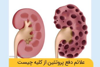 دفع پروتئین از کلیه