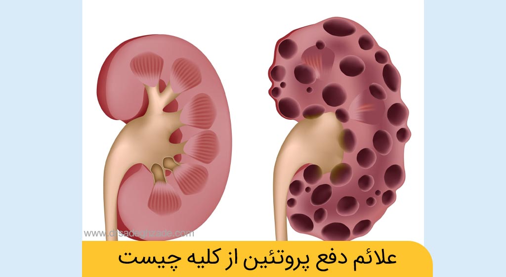 دفع پروتئین از کلیه