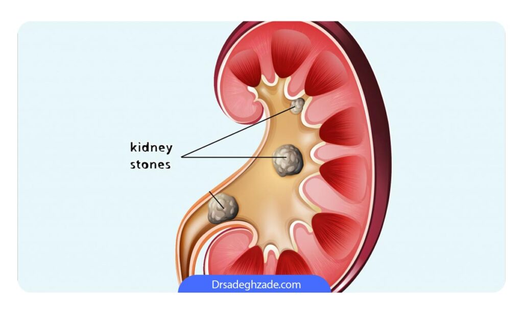 تصویر سنگ کلیه 