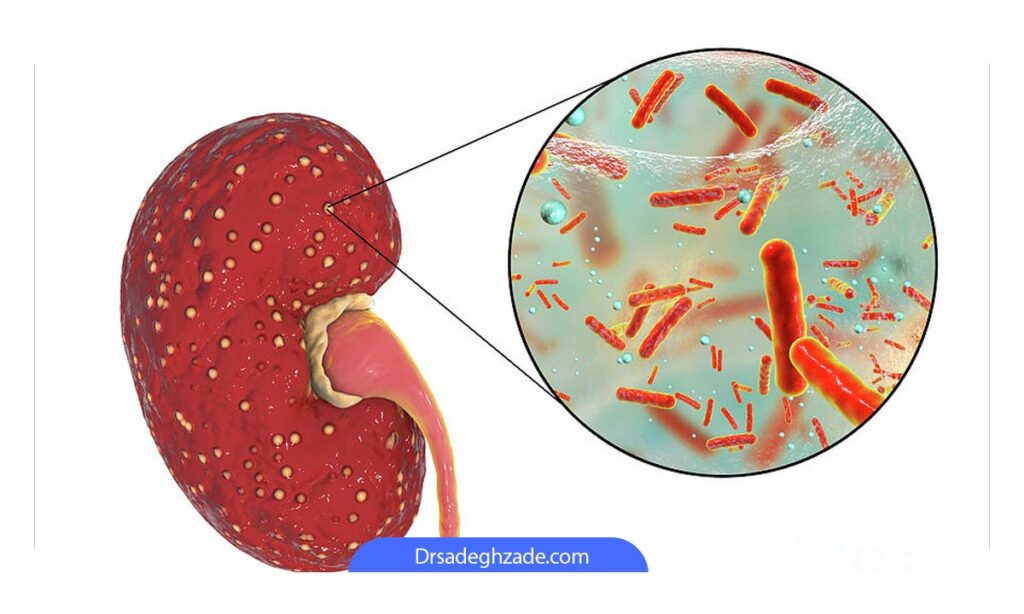 تصویر شماتیک از عفونت کلیه