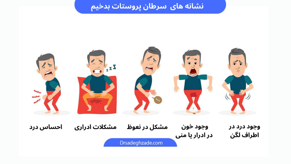 تصویر شماتیک از نشانه های سرطان پروستات 