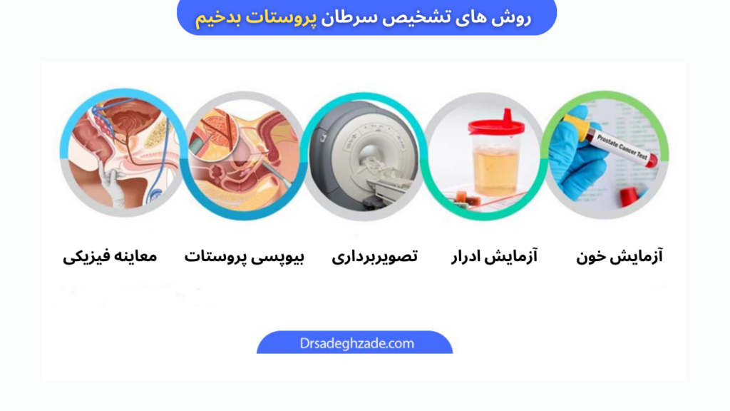 تشخیص سرطان پروستات بدخیم 