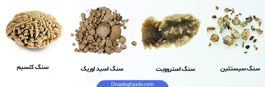 عکس از انواع سنگ کلیه 