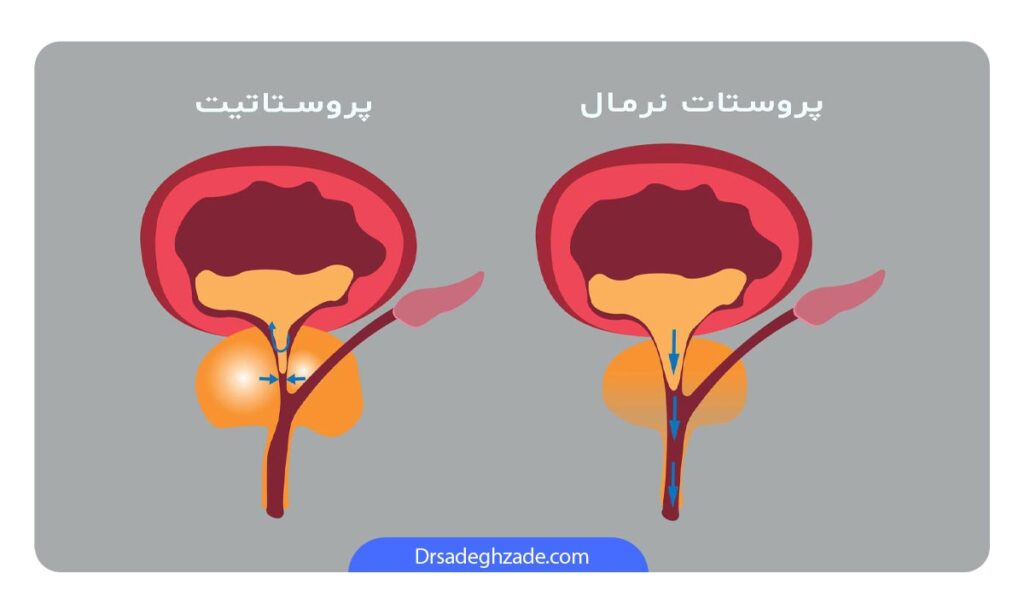 تصویر پروستات نرمال و پروستاتیت 