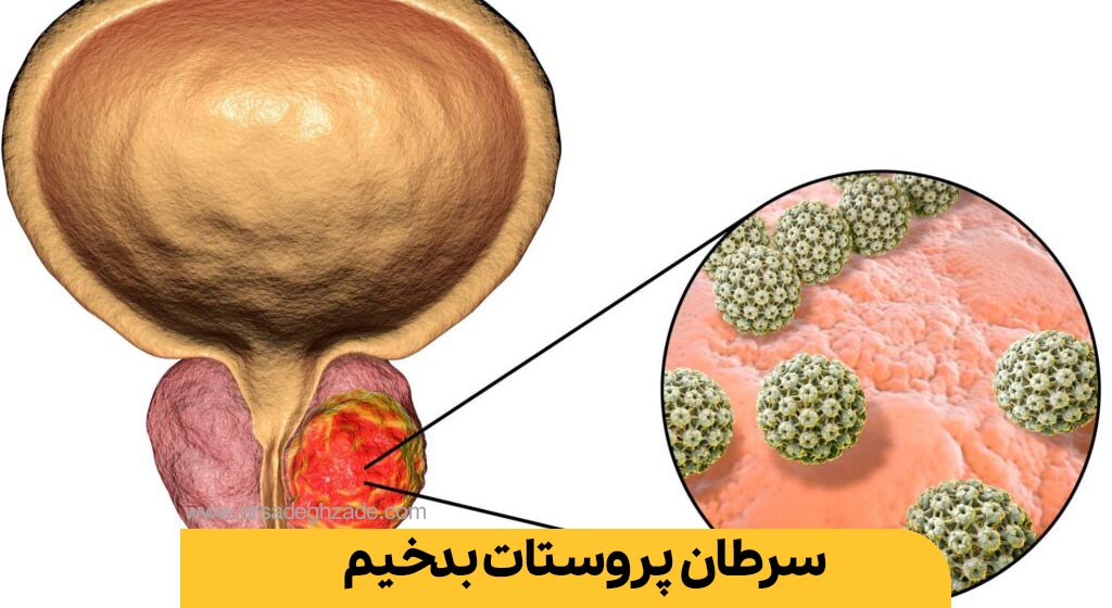 سرطان پروستات بدخیم