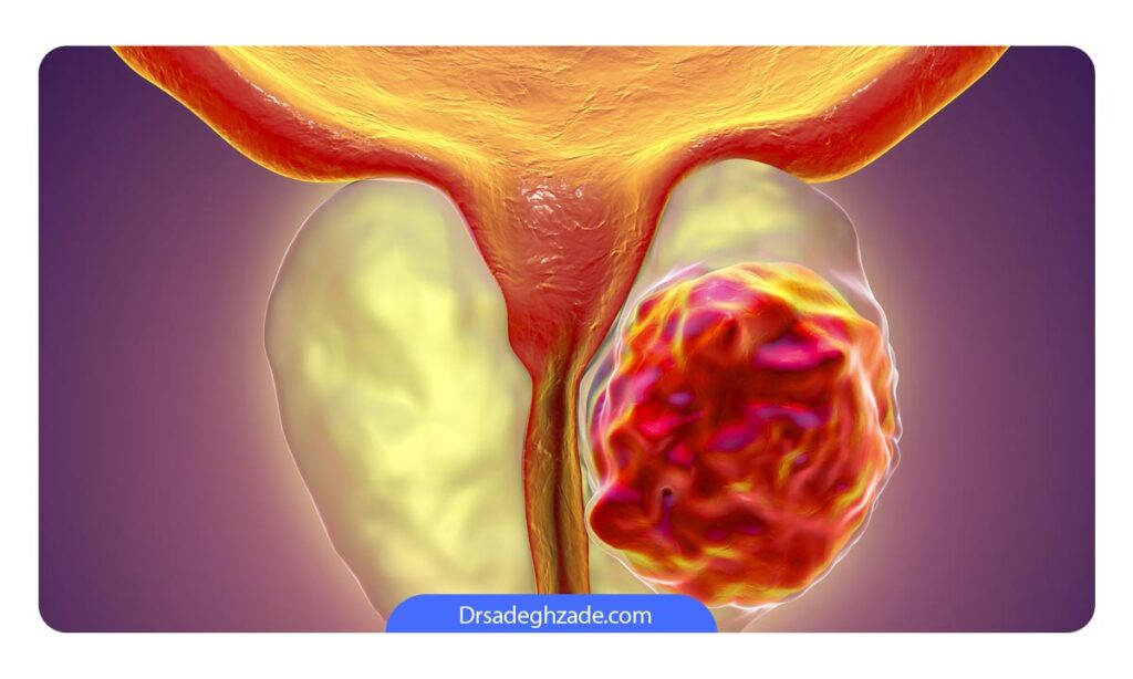 روش های درمان سرطان پروستات بدخیم 