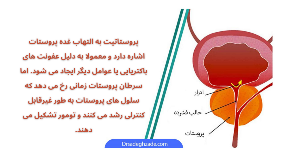 تفاوت پروستاتیت با سرطان پروستات 