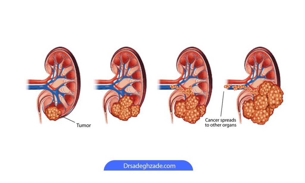 تصویری از مراحل پیشرفت سرطان کلیه 