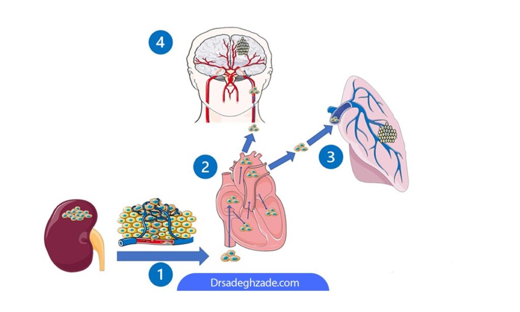 تصویر شماتیک از چرخه متاستاز سرطان کلیه