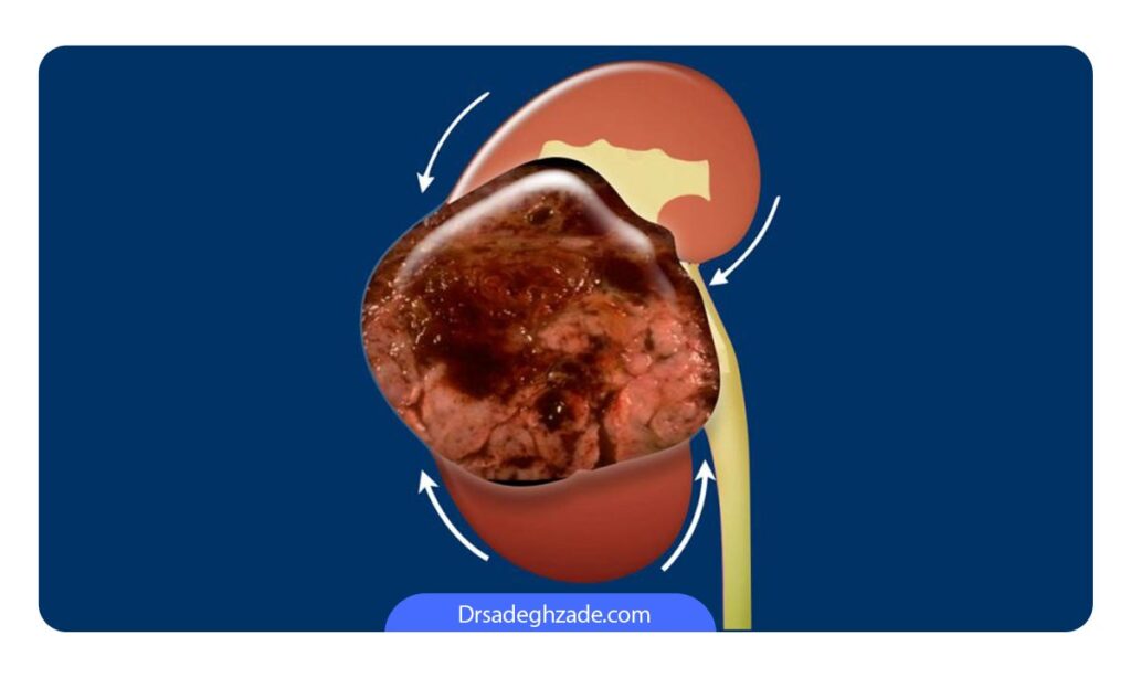 سرطان کلیه بدخیم یا پیشرفته