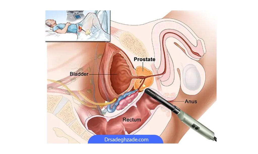 تصویری از روش سونوگرافی ترانس رکتال 