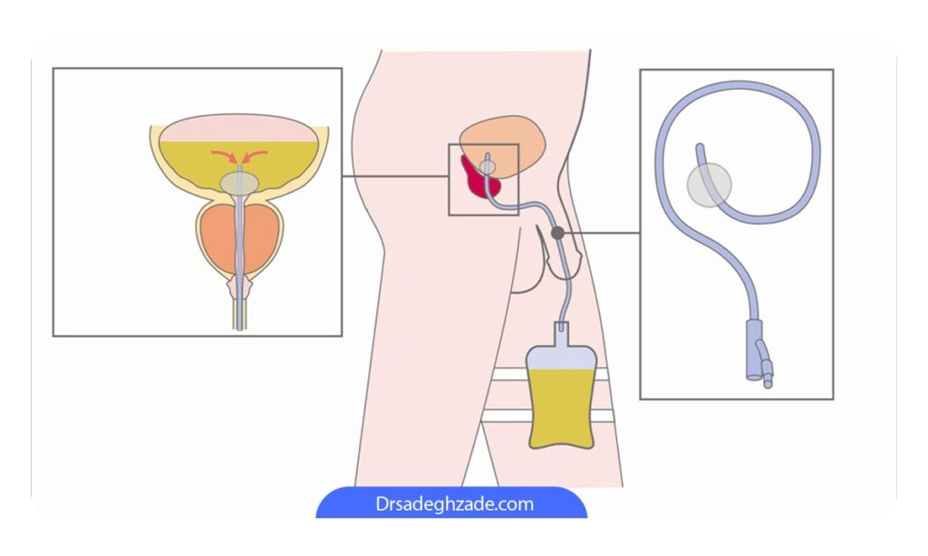 استفاده از کاتتر به دفع ادرار بدون فشار به مجرای ادراری کمک می ‌کند