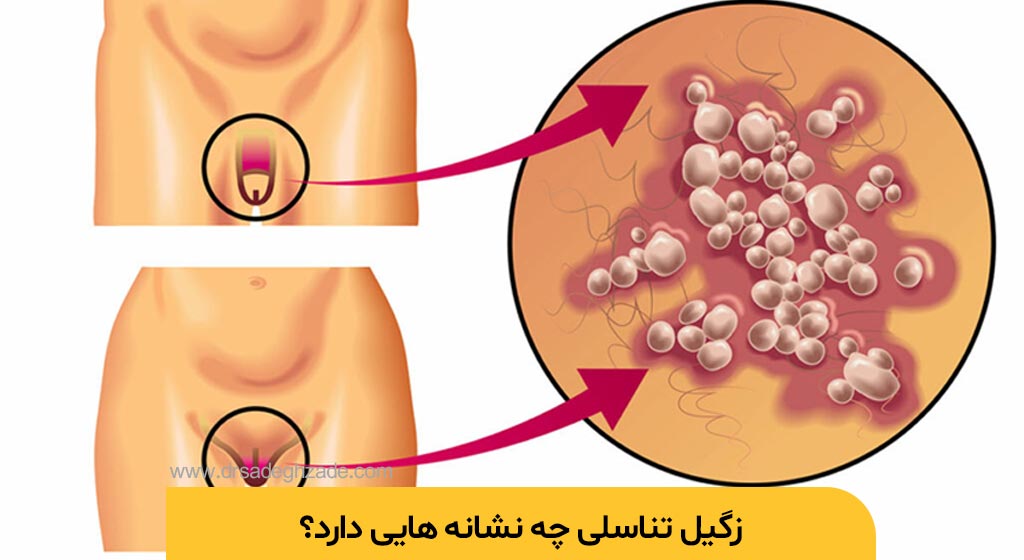 تبخال تناسلی چیست