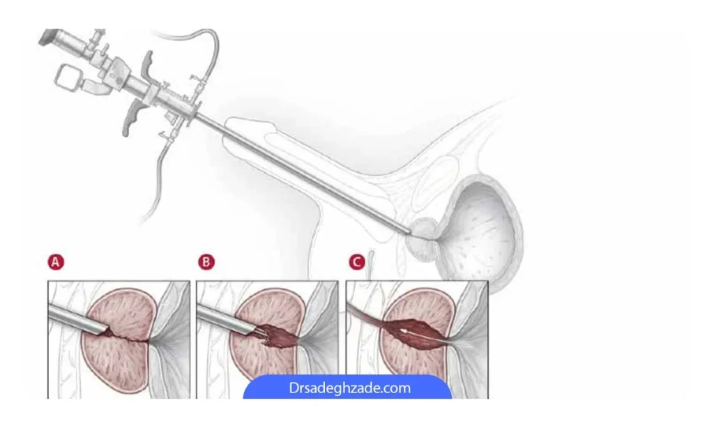 روش TURP 